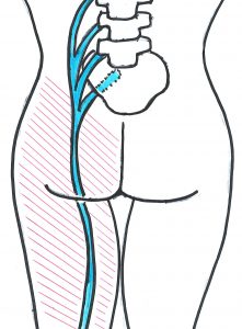 Relief from sciatica and chronic low back pain Asheville's Art of Chiropractic